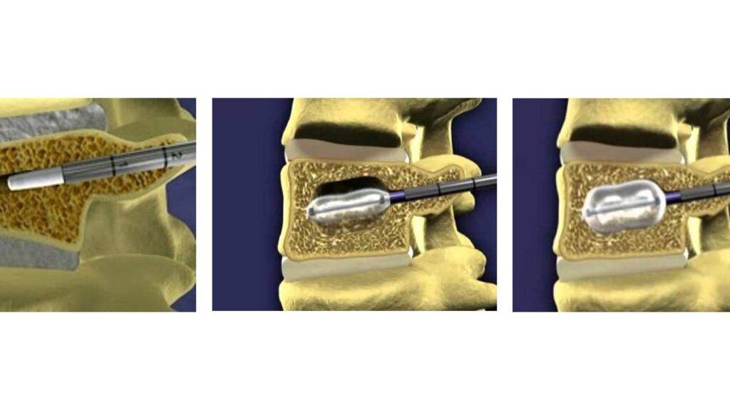 Cifoplastia: o tratamento minimamente invasivo para fraturas na coluna